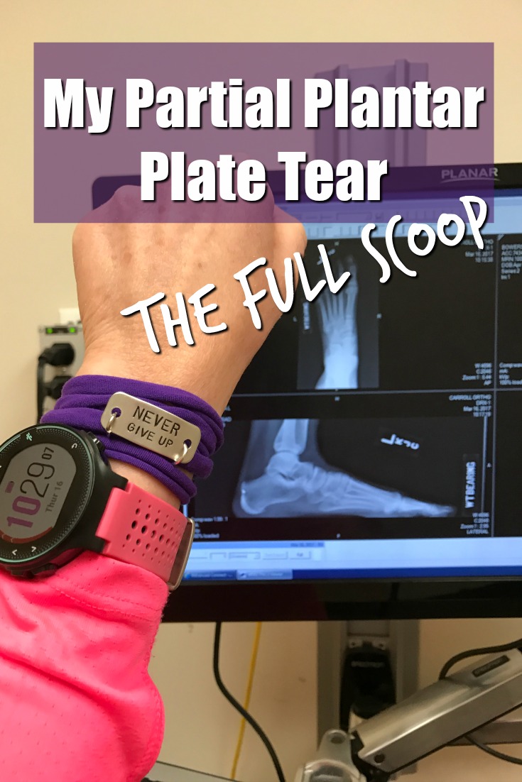 My Partial Plantar Plate Tear: The Full Scoop
