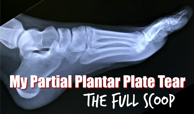 My Partial Plantar Plate Tear Injury: The Full Scoop