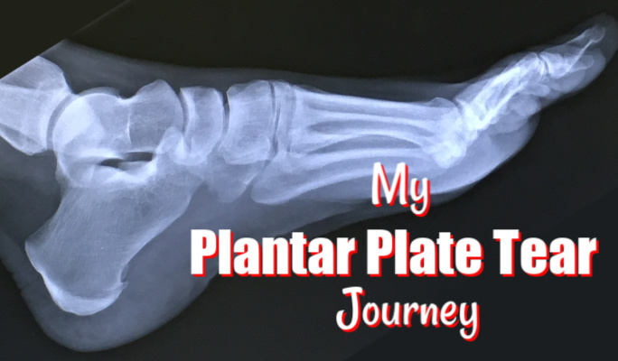 My Partial Plantar Plate Tear Journey